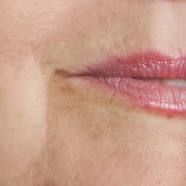 Juvederm after image