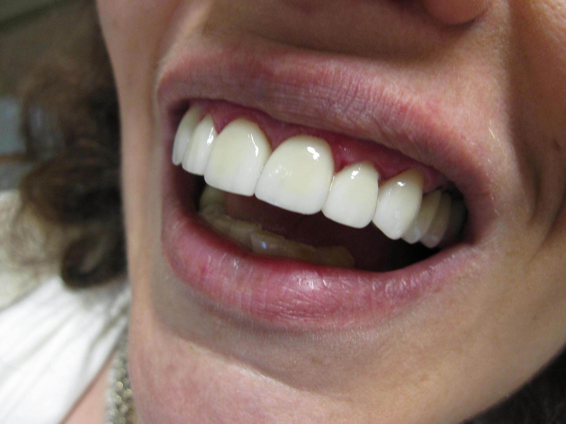 veneers-after image