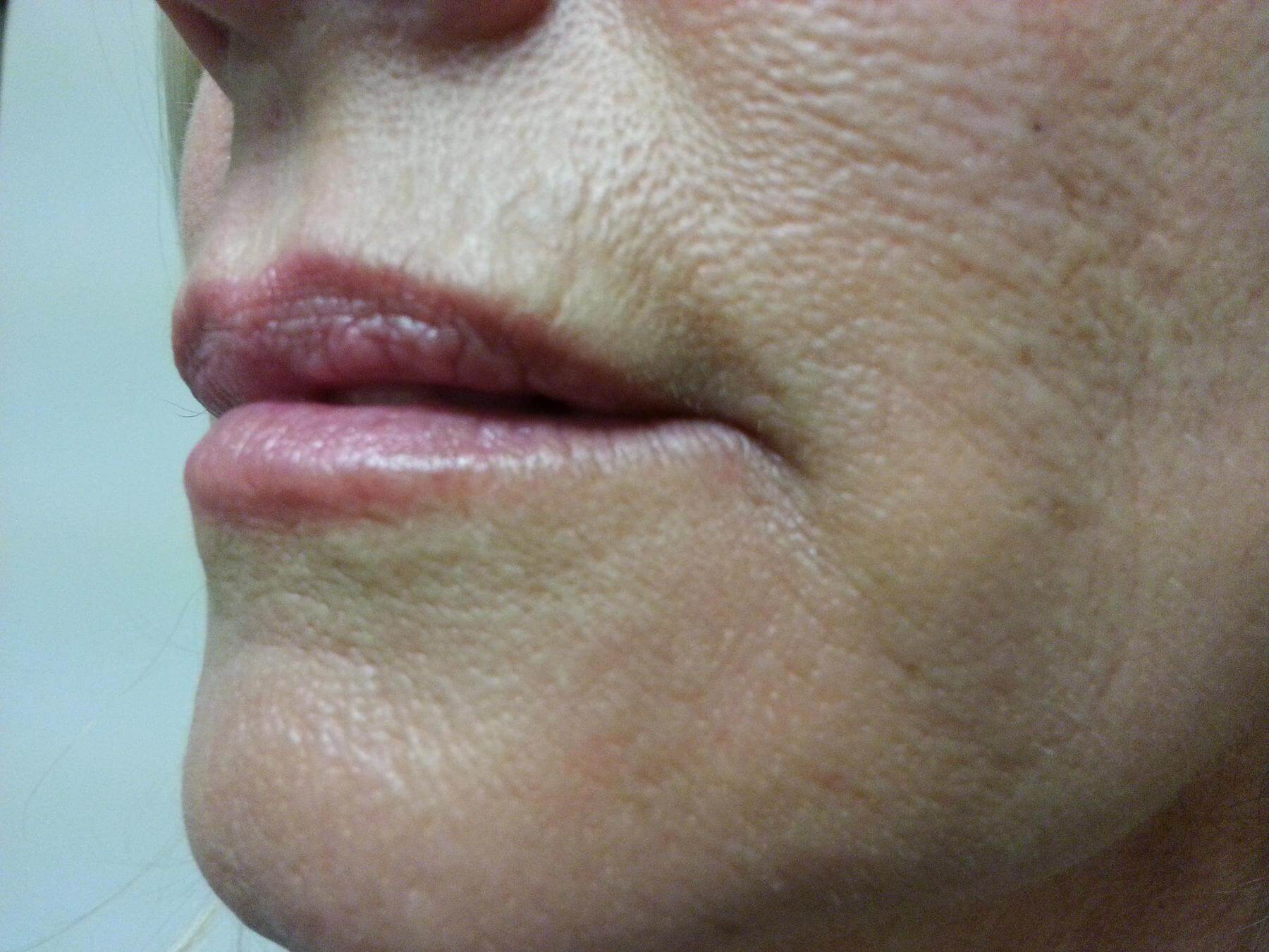 dermafiller after image