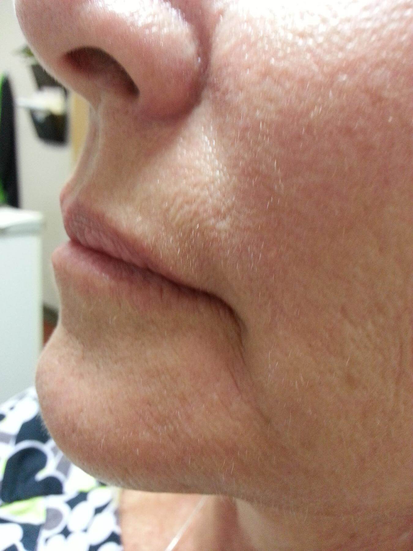dermafiller after image