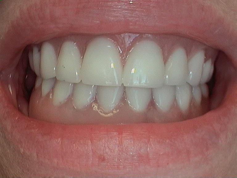 implants after